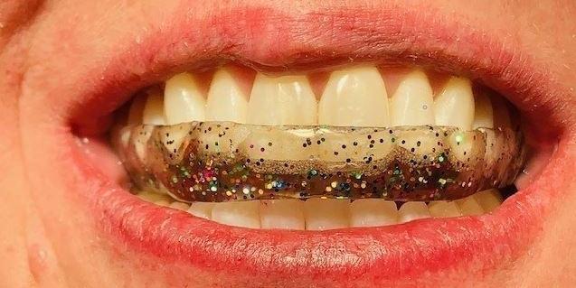 Bite Guards | Dentist