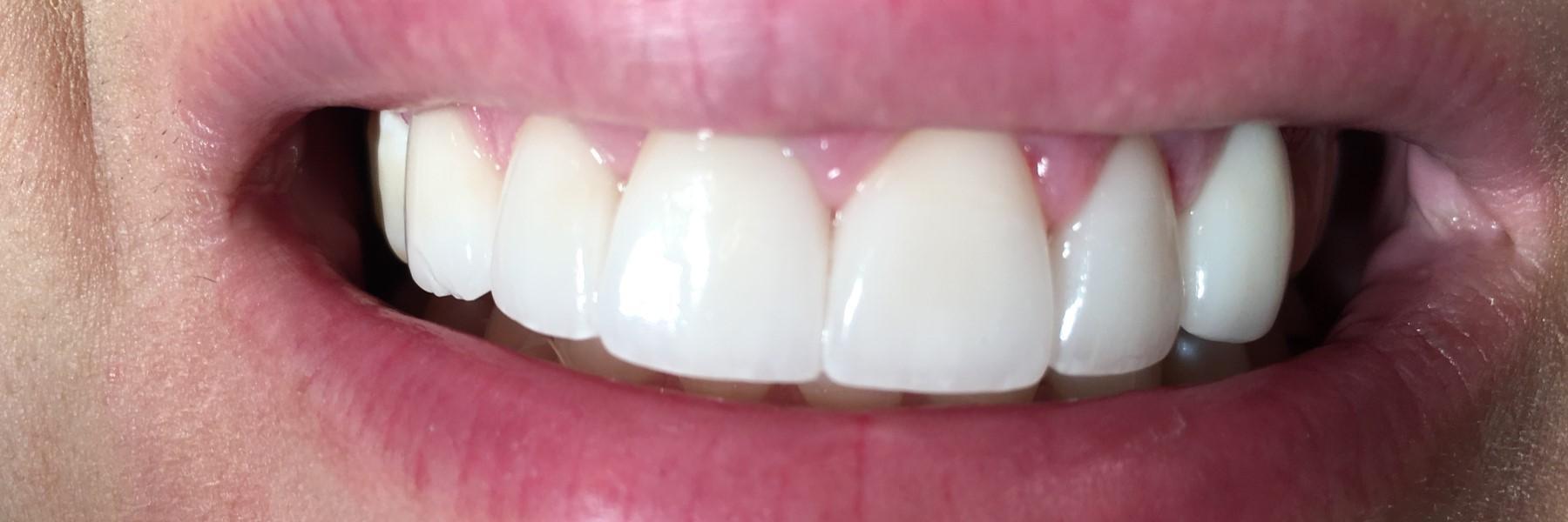 Bonding and Veneers | Dentist