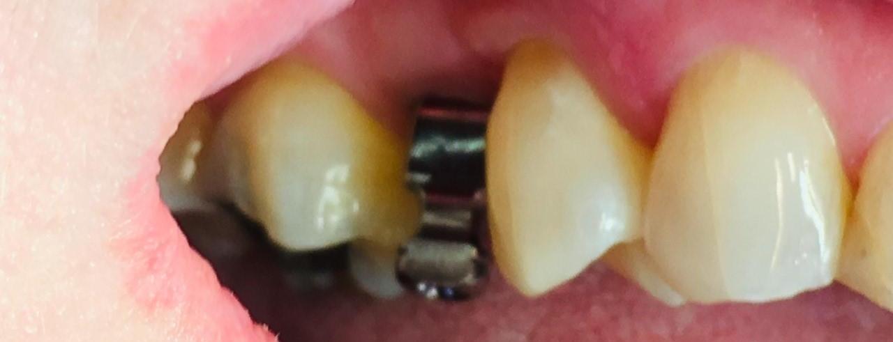 Dental Implants | Dentist