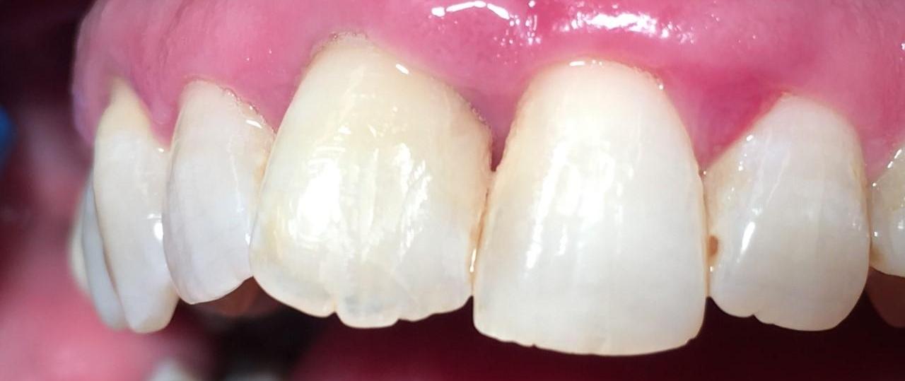 Gum Disease Treatment | Dentist