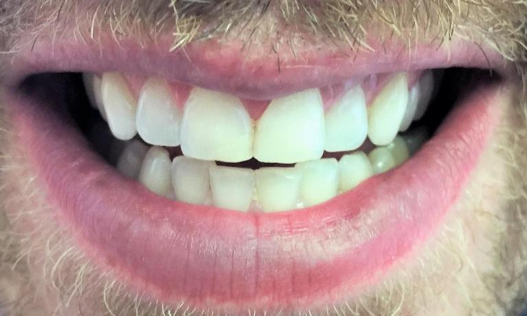 White-Fillings-After-Image