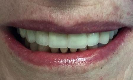Veneers-After-Image
