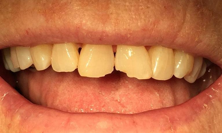 White-Fillings-Before-Image