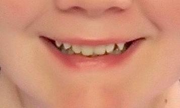 Cosmetic-Bonding-Before-Image