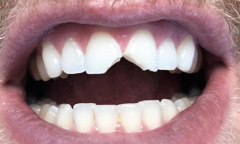 White-Fillings-Before-Image