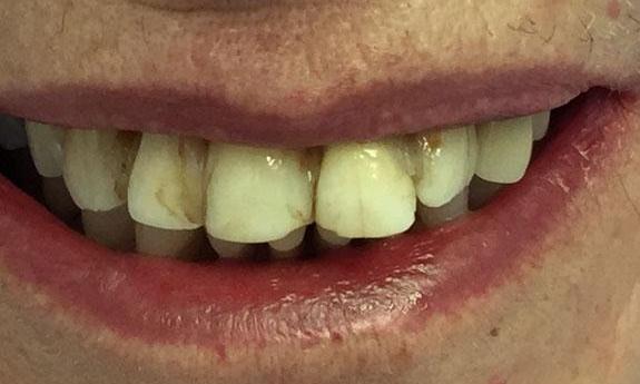 Veneers-Before-Image